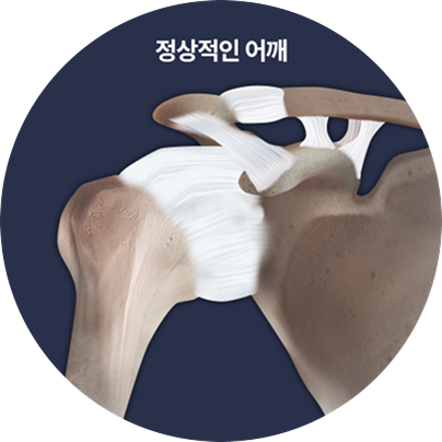 정상적인 어깨