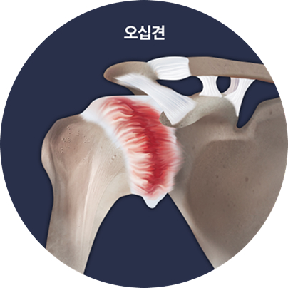 오십견