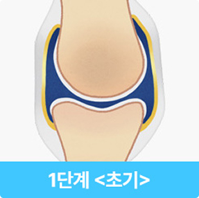 퇴행성관절염 초기 이미지