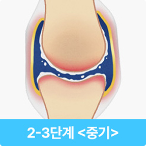 퇴행성관절염 중기 이미지