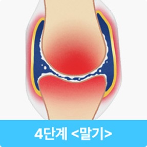 퇴행성관절염 말기 이미지
