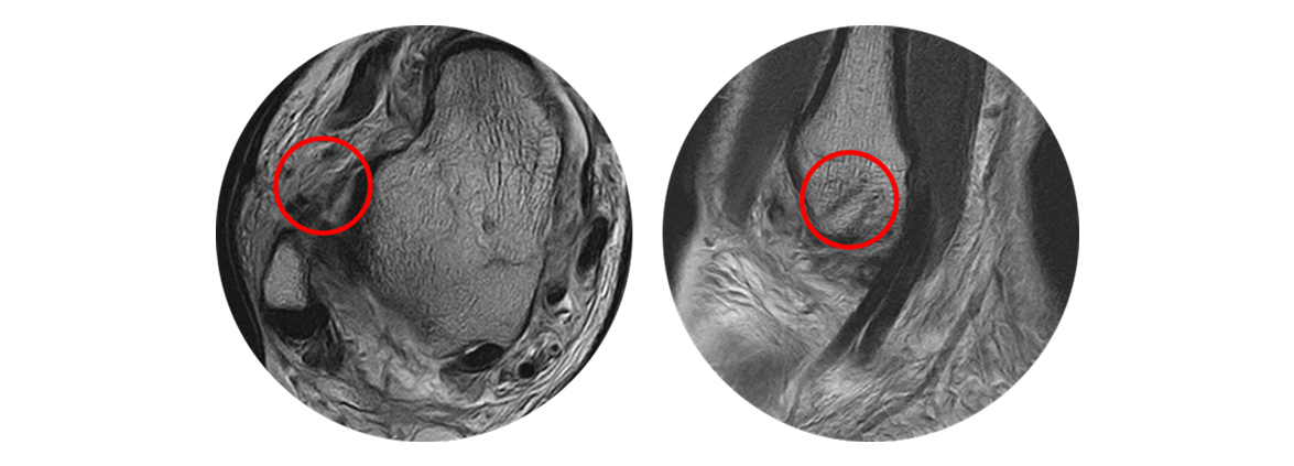 제1 신전지대 유리술 MRI 검사 이미지