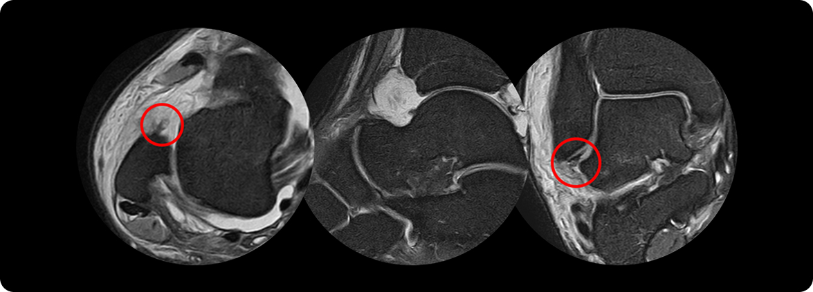 제1 신전지대 유리술 MRI 검사 이미지